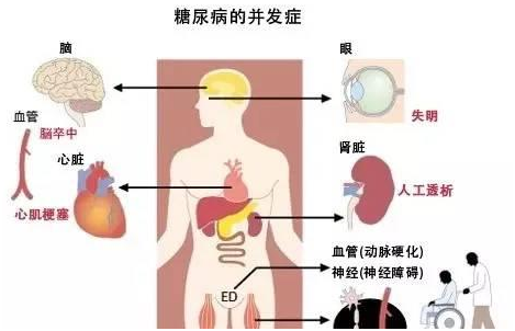 老年糖尿病有何特點？如何識別？3.png